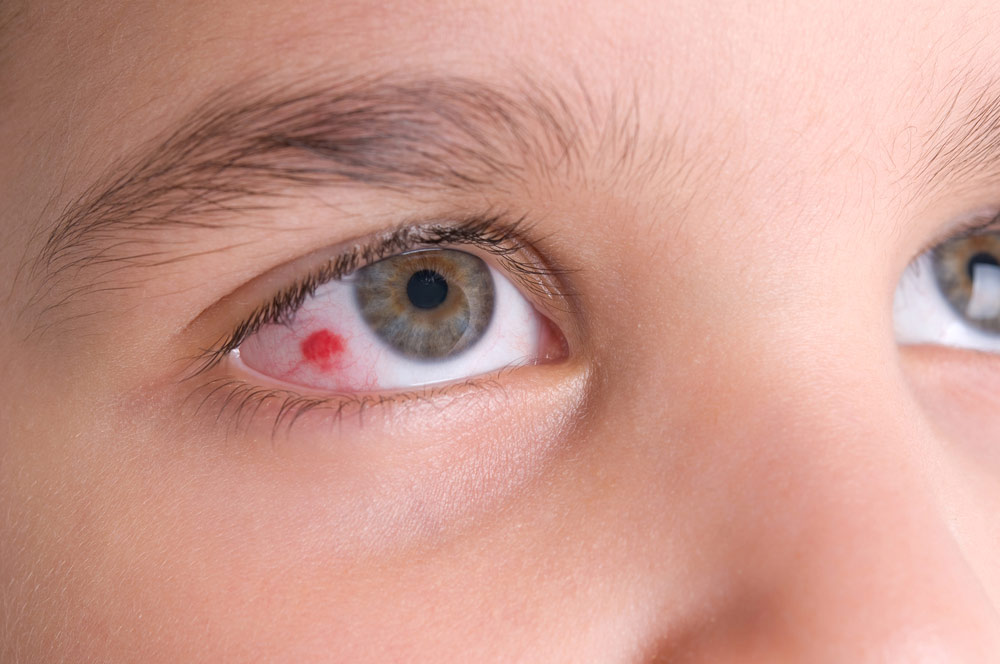 common causes for Pink Eye